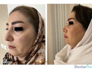 نمونه عمل بینی دکتر هاشم پویا 1