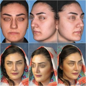 نمونه عمل بینی دکتر حسام جهاندیده 2