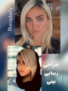 نمونه عمل بینی دکتر ماریا مرادی3