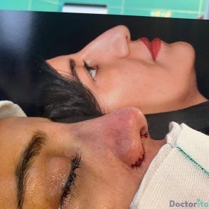 نمونه عمل بینی دکتر امیرعلی میرفخرایی 1
