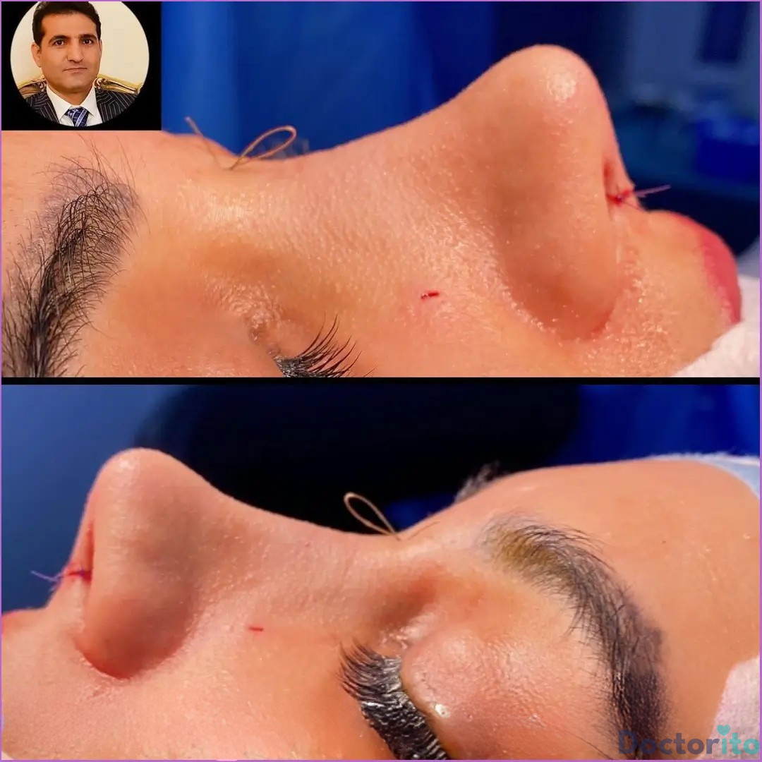 نمونه عمل بینی دکتر امید قاسم زاده 5