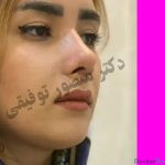 نمونه عمل بینی دکتر منصور توفیقی2