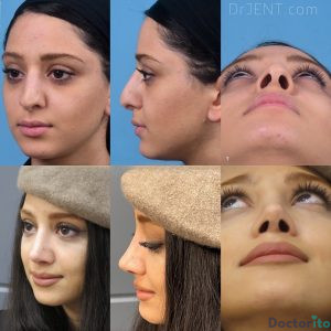 نمونه عمل بینی دکتر حسام جهاندیده 6
