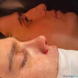 نمونه عمل بینی دکتر امیرعلی میرفخرایی 4
