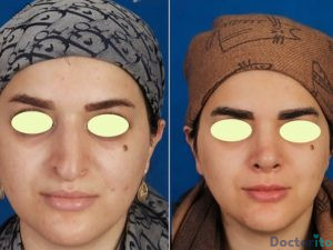 نمونه عمل بینی دکتر صمد غیاثی 1