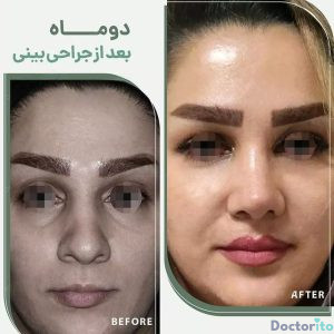 نمونه عمل بینی دکتر هادی سرمست6
