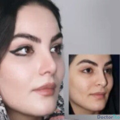 نمونه عمل بینی دکتر امیر نیازی 3
