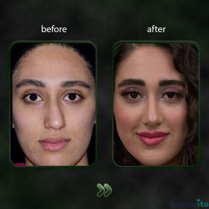 نمونه عمل بینی دکتر شاهین باستانی نژاد 3