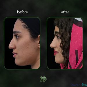 نمونه عمل بینی دکتر شاهین باستانی نژاد 4