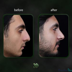 نمونه عمل بینی دکتر شاهین باستانی نژاد 1