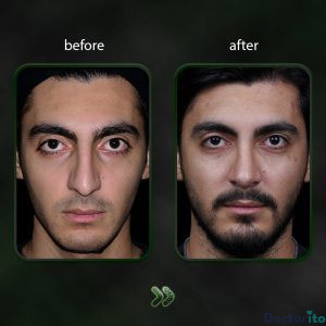 نمونه عمل بینی دکتر شاهین باستانی نژاد 2