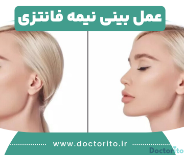 عمل بینی نیمه فانتزی