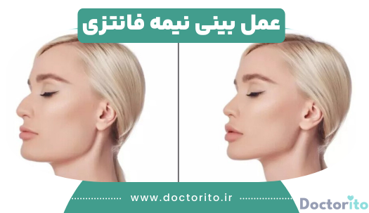 عمل بینی نیمه فانتزی