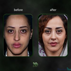 نمونه عمل بینی دکتر شاهین باستانی نژاد 6