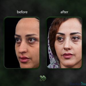 نمونه عمل بینی دکتر شاهین باستانی نژاد 5