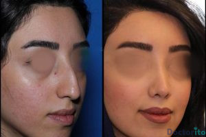 نمونه عمل بینی دکتر علیرضا عالیان (1)