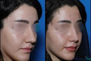 نمونه عمل بینی دکتر علیرضا عالیان (2)