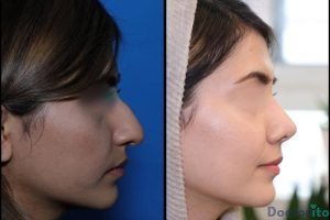 نمونه عمل بینی دکتر علیرضا عالیان (3)