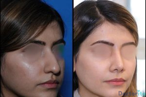 نمونه عمل بینی دکتر علیرضا عالیان (4)