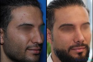 نمونه عمل بینی دکتر علیرضا عالیان (6)