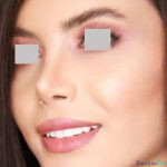 نمونه جراحی بینی دکتر امید قاسم زاده (1)