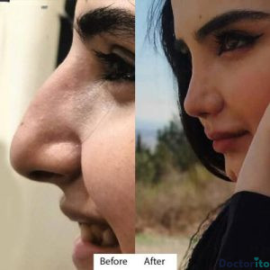 نمونه عمل بینی دکتر آتوسا ضیغمی 5