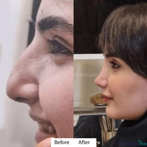 نمونه عمل بینی دکتر آتوسا ضیغمی 3