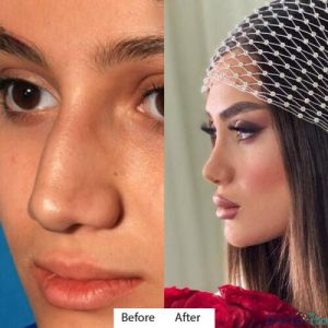 نمونه عمل بینی دکتر آتوسا ضیغمی 2