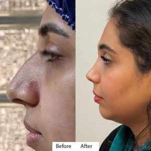 نمونه عمل بینی دکتر آتوسا ضیغمی 1