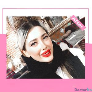 نمونه عمل بینی دکتر آرزو خوانسای نیا 6