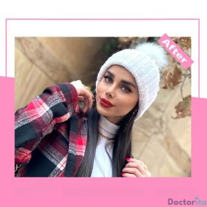 نمونه عمل بینی دکتر آرزو خوانسای نیا 4