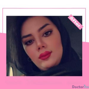نمونه عمل بینی دکتر آرزو خوانسای نیا 2