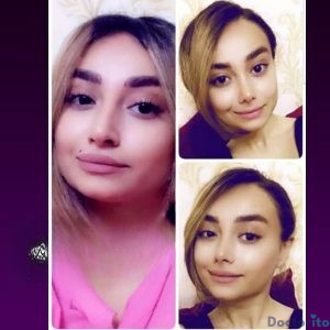 نمونه عمل بینی دکتر ابراهیم شهسواری 3