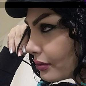 نمونه عمل بینی دکتر ابراهیم شهسواری 4