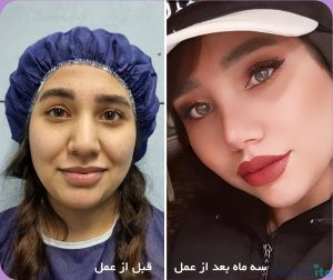 نمونه عمل بینی دکتر امید اعتماد 1