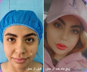 نمونه عمل بینی دکتر امید اعتماد 2