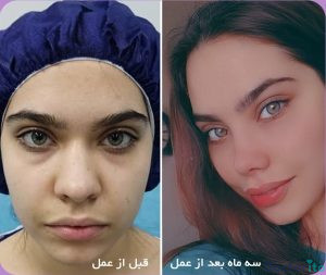 نمونه عمل بینی دکتر امید اعتماد 3