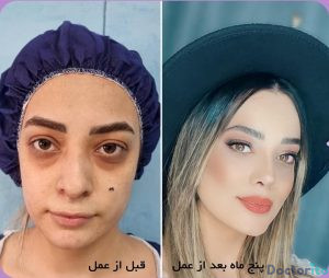 نمونه عمل بینی دکتر امید اعتماد 4