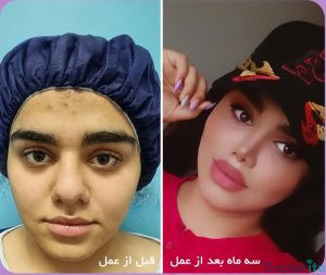 نمونه عمل بینی دکتر امید اعتماد 5