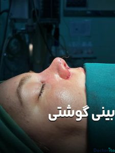 نمونه عمل بینی دکتر امیر دریانی 1
