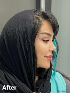 نمونه عمل بینی دکتر امیر دریانی 5