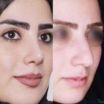 نمونه عمل بینی دکتر امیر نیازی 2