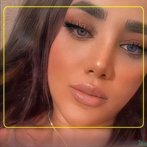 نمونه عمل بینی دکتر اکبر اعتمادی 1