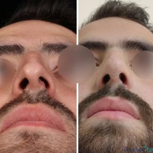 نمونه عمل بینی دکتر جلال قیاسی (5)