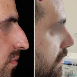 نمونه عمل بینی دکتر جلال قیاسی (6)