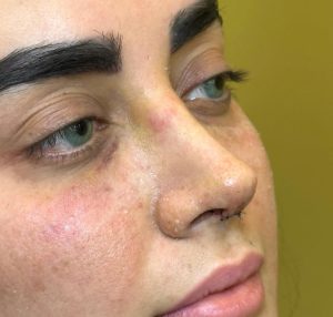 نمونه عمل بینی دکتر حمیدرضا نوری (1)
