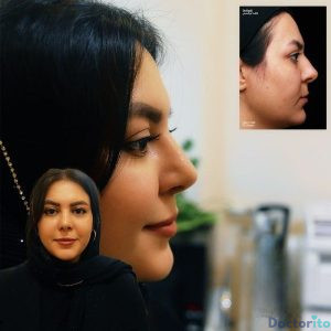 نمونه عمل بینی دکتر حمیدرضا راستی 5