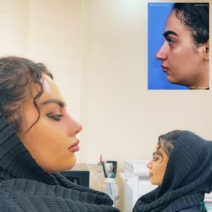 نمونه عمل بینی دکتر حمیدرضا راستی 4