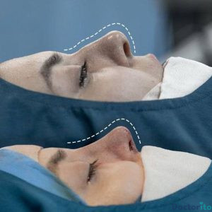 نمونه عمل بینی دکتر حمیدرضا راستی 3