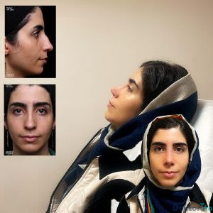 نمونه عمل بینی دکتر حمیدرضا راستی 1